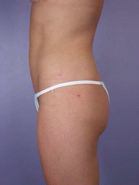 Liposuction before and after photo