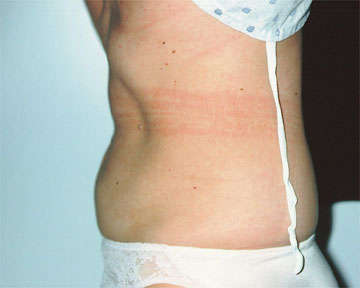 Liposuction before and after photo