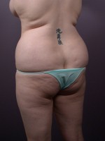 Liposuction Before and after photo