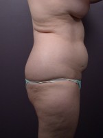 Liposuction Before and after photo