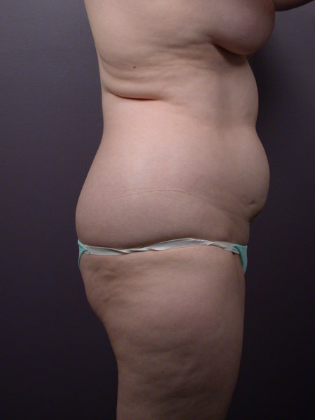 Liposuction before and after photo