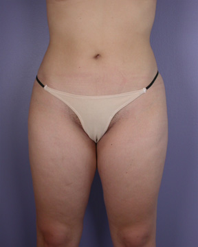 Liposuction before and after photo