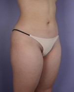 Liposuction Before and after photo