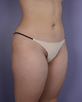 Liposuction before and after photo