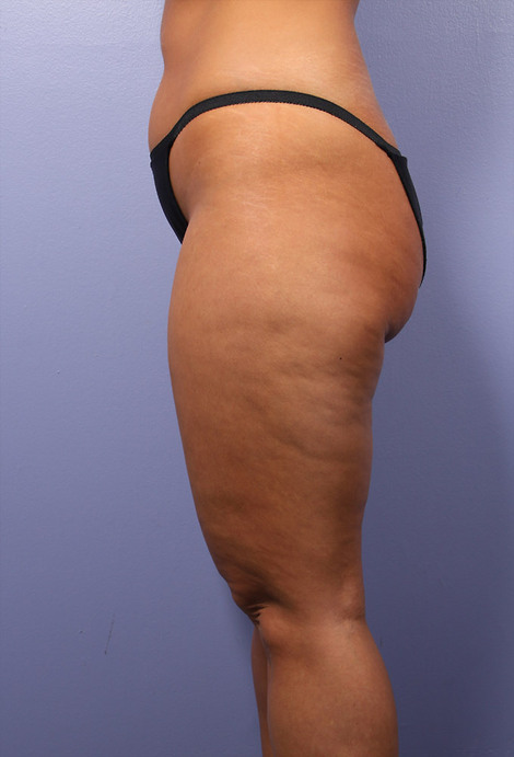 Liposuction before and after photo