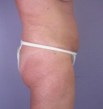 Liposuction Before and after photo