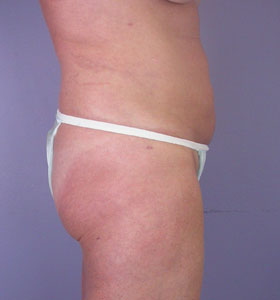 Liposuction before and after photo