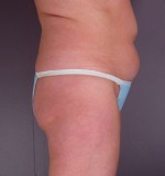 Liposuction Before and after photo