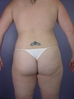 Liposuction Before and after photo