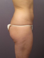 Liposuction Before and after photo