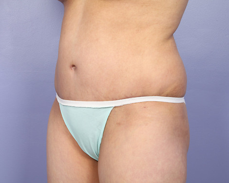 Liposuction before and after photo