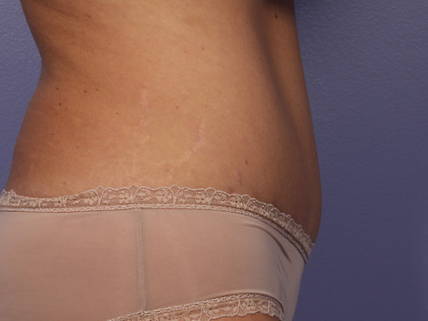 Liposuction before and after photo