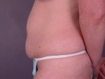 Liposuction Before and after photo