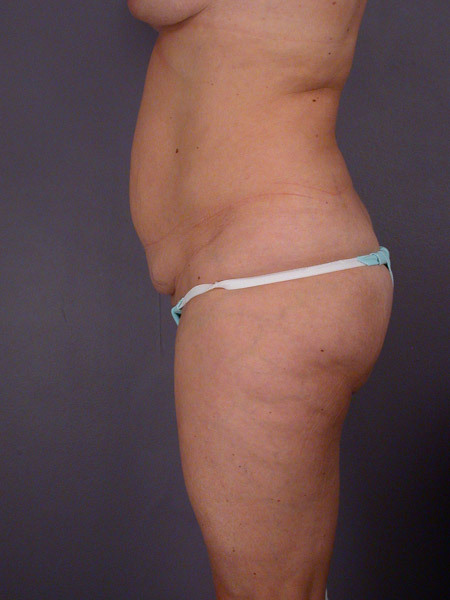 Liposuction before and after photo