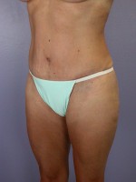 Liposuction Before and after photo