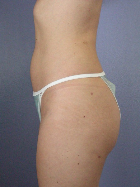 Liposuction before and after photo