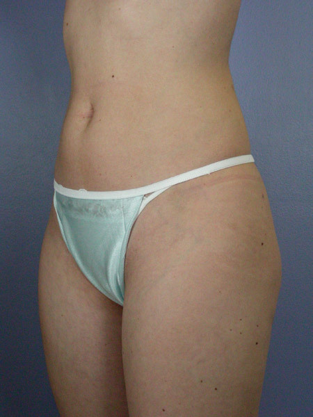 Liposuction before and after photo