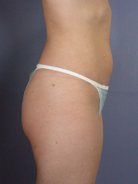 Liposuction before and after photo