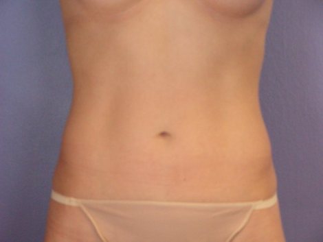 Liposuction before and after photo