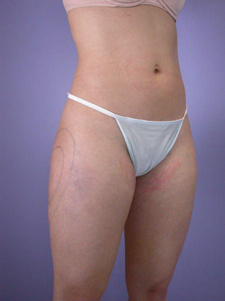 Liposuction before and after photo