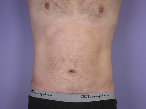 Liposuction before and after photo