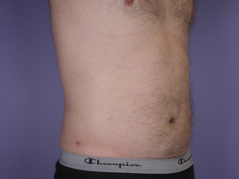 Liposuction before and after photo