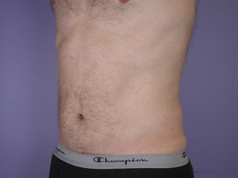 Liposuction before and after photo