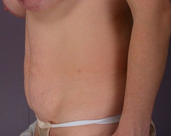 Tummy Tuck before and after photo