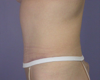 Tummy Tuck before and after photo