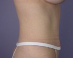 Tummy Tuck Before and after photo