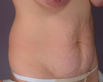 Tummy Tuck before and after photo