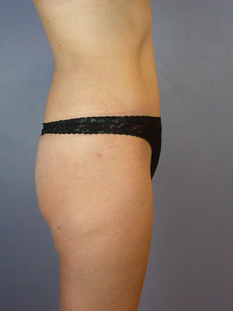 Tummy Tuck before and after photo