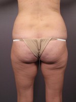 Tummy Tuck Before and after photo