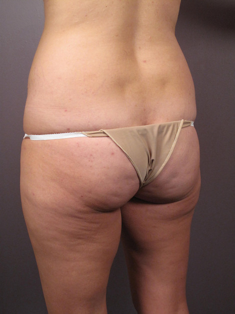 Tummy Tuck before and after photo