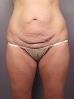 Tummy Tuck