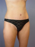 Tummy Tuck Before and after photo