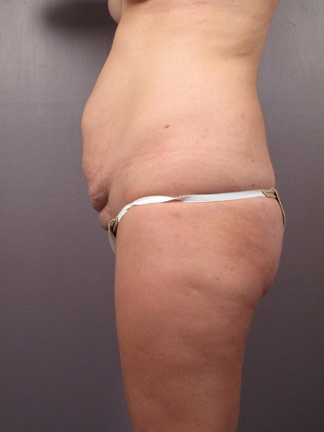 Tummy Tuck before and after photo