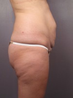 Tummy Tuck Before and after photo