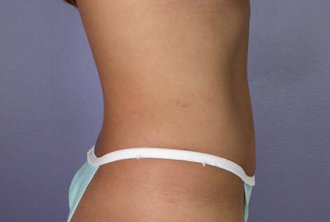 Tummy Tuck before and after photo