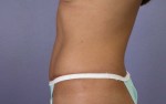 Tummy Tuck Before and after photo