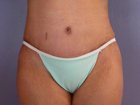 Tummy Tuck before and after photo