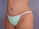 Tummy Tuck Before and after photo