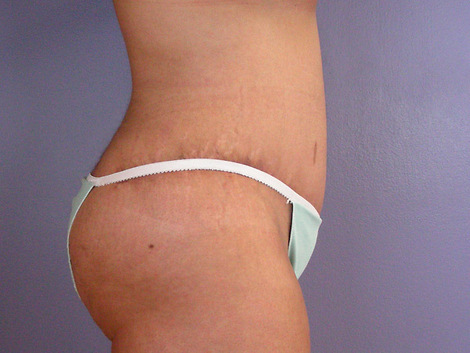 Tummy Tuck before and after photo