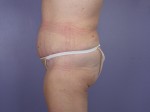 Tummy Tuck Before and after photo