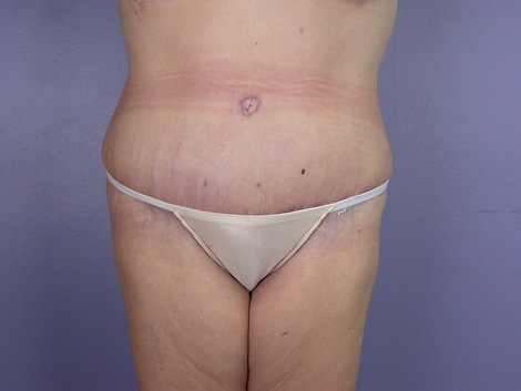 Tummy Tuck before and after photo