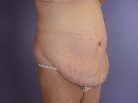 Tummy Tuck before and after photo