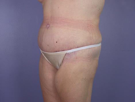 Tummy Tuck before and after photo