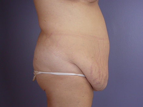 Tummy Tuck before and after photo