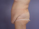 Tummy Tuck Before and after photo