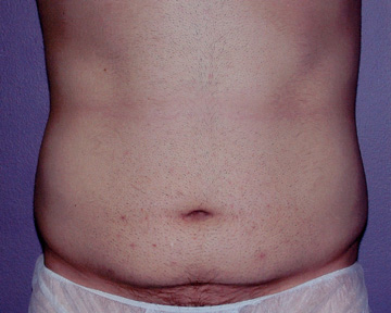 Tummy Tuck before and after photo